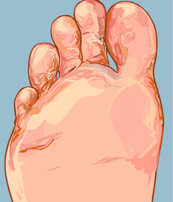 Digital Drawing of Athlete's Foot